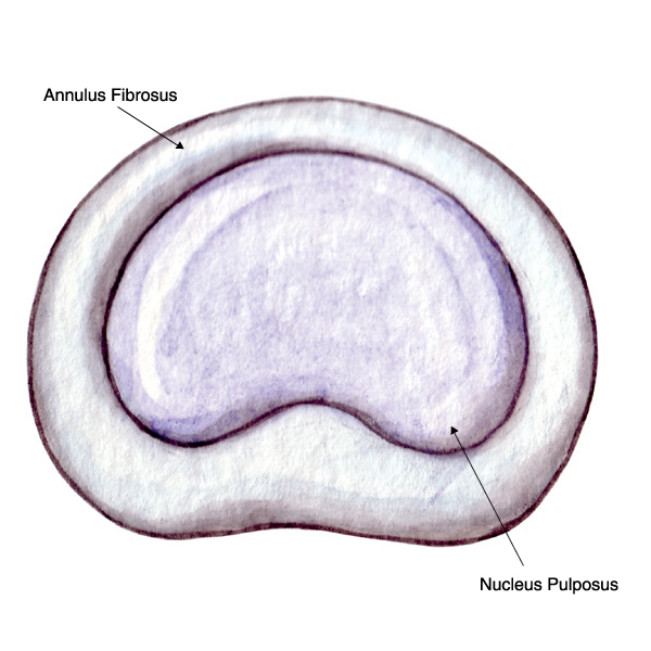 herniated disc